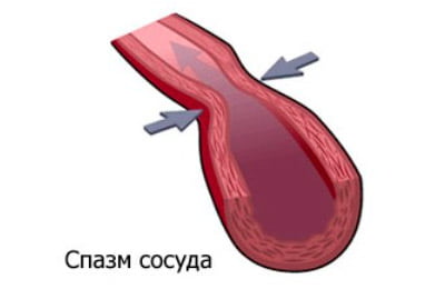 Спазм сосудов