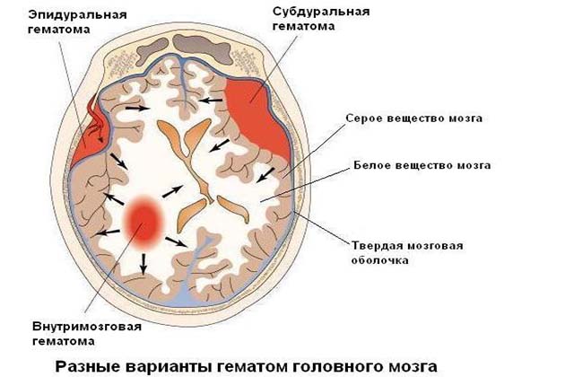 Виды гематом