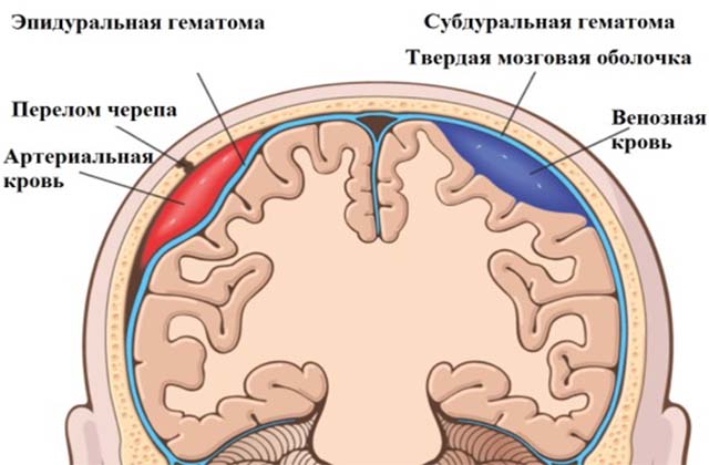 Эпидуральная гематома