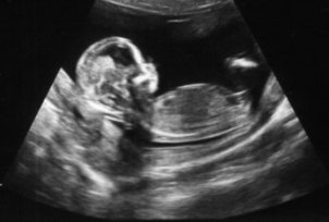 УЗИ на ранних сроках беременности фото