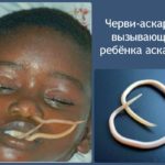 аскаридоз у ребенка