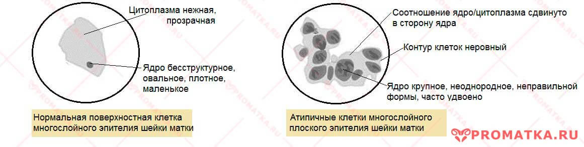Атипичные клетки