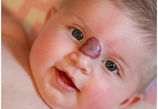 родимое пятно на носу у ребенка