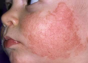 Симптомы атопического дерматита у детей до года