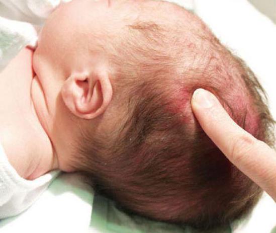 гематома у ребенка на голове при рождении