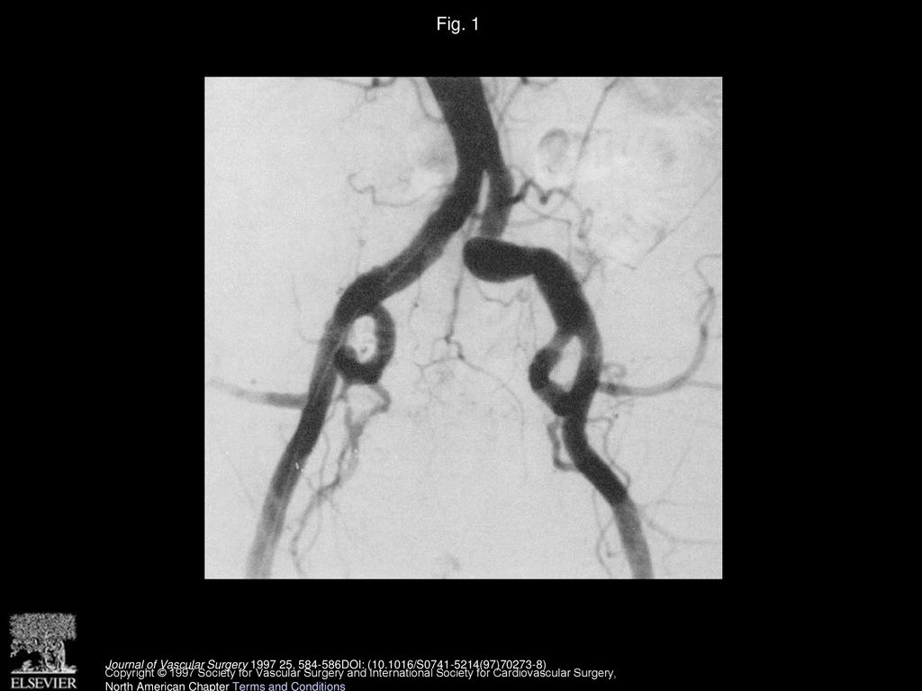 Fig. 1 Front view arteriograph failed to visualize any abnormalities.