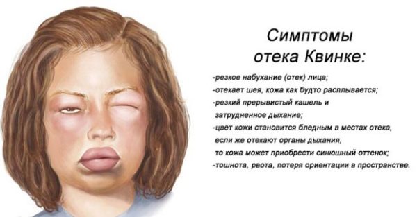 Главные симптомы отека Квинке