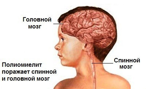 Места поражения полиомиелитом