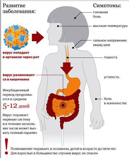 Симптомы и развитие полиомиелита