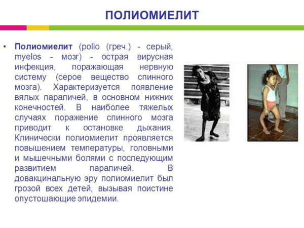 Что такое полиомиелит