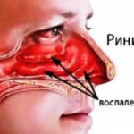 Симптомы ринитов