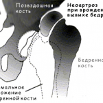 анатомия вывиха бедра 