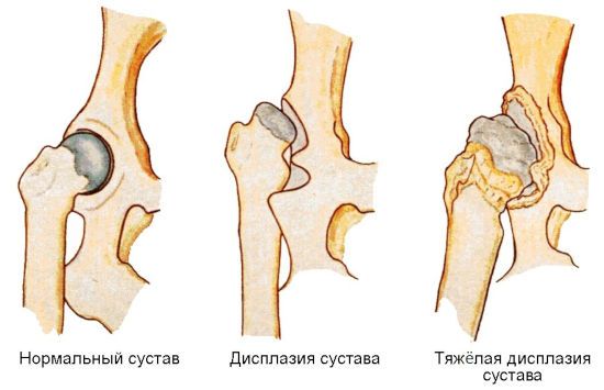 Смещение головки бедренной кости