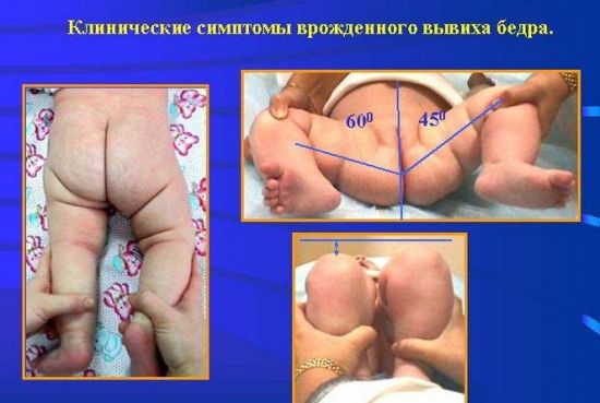 Измерение угла тазобедренных суставов