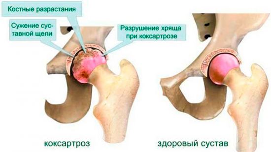 Разрушенный сустав