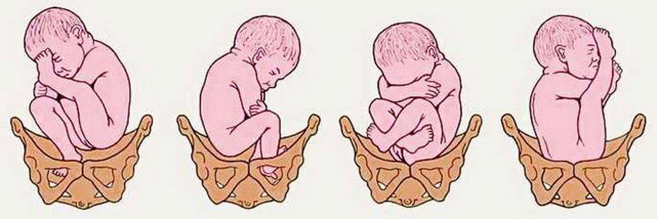 Тазовое предлежание 