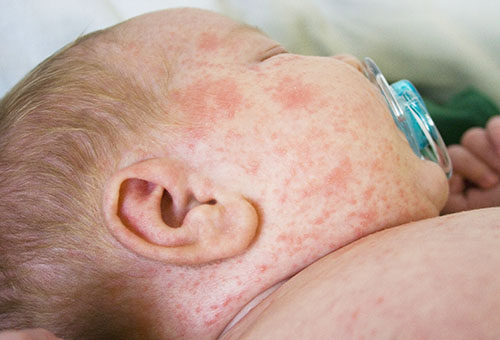 Аллергия на череду у ребенка