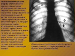 Рентген грудной клетки для диагностики хрипов 