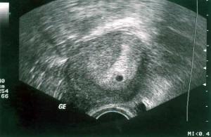 Беременности 4 недели - УЗИ