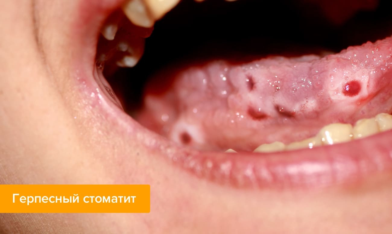 Герпесный стоматит Фото герпесного стоматита