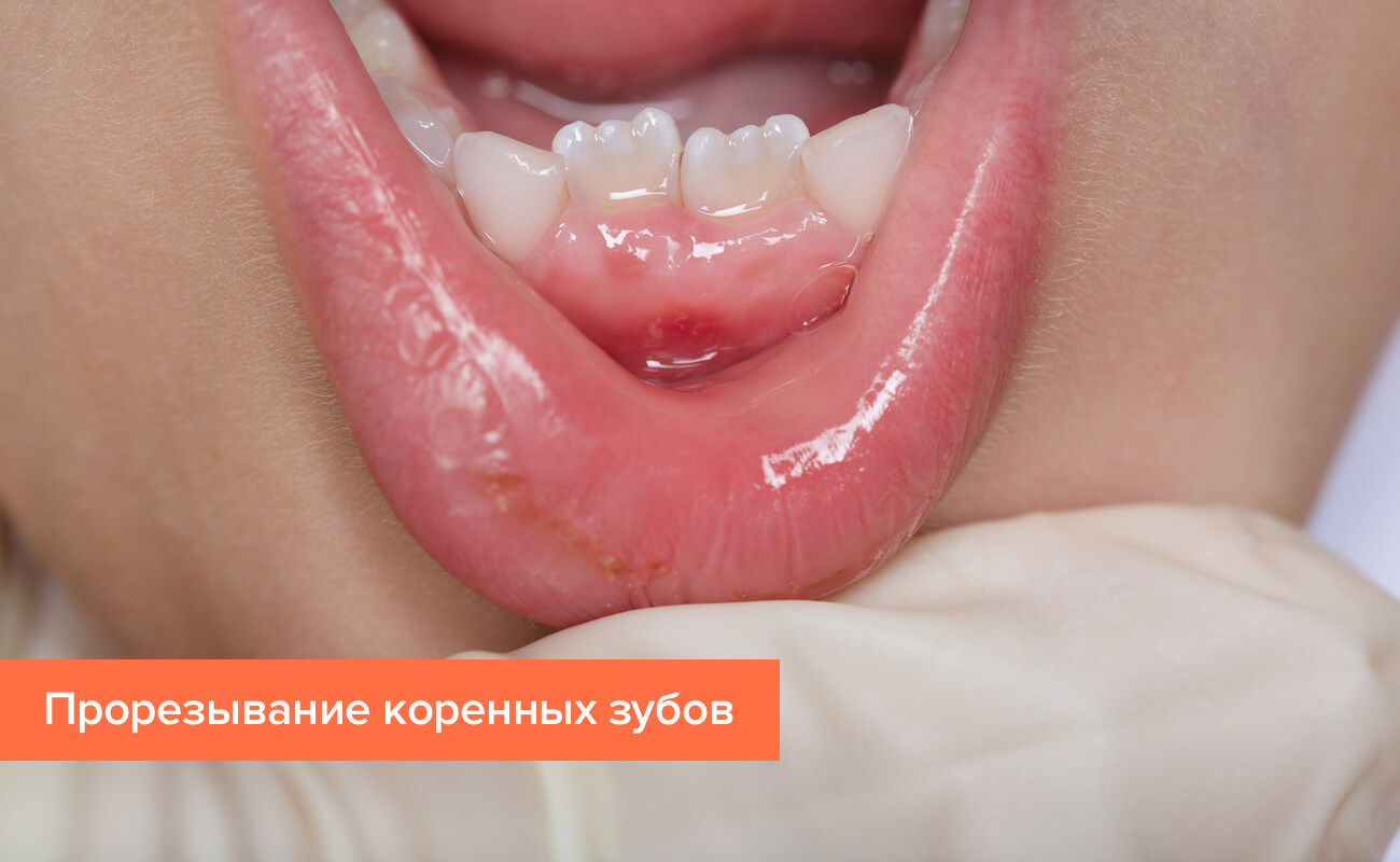 Прорезывание коренных зубов у ребенка Фото прорезывания коренных зубов у ребенка