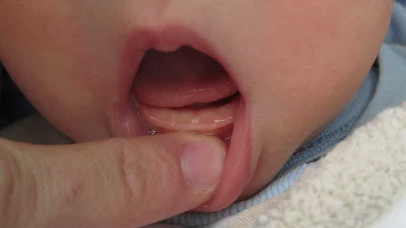 Cколько дней прорезываются первые зубы у ребенка: точные сроки